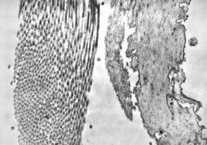 F,39y. | collagen and elastin - aorta F,39y. | collagen and elastin - aorta